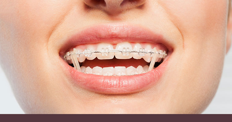 Wear Rubber Bands For Braces 